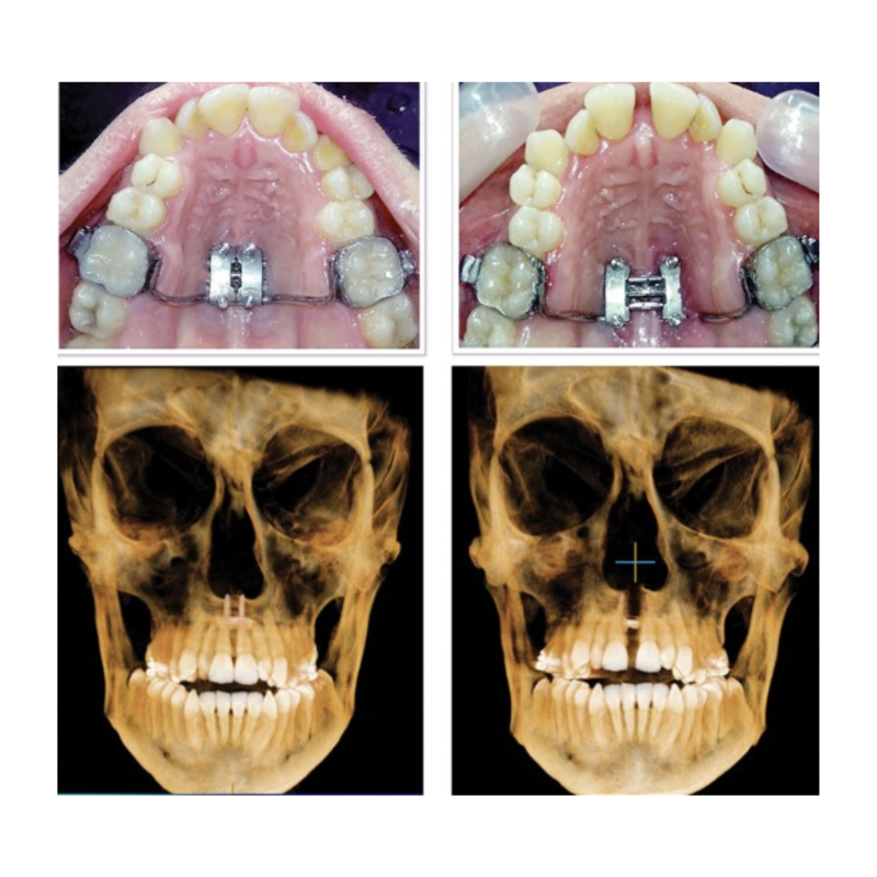 Orthodontic treatment and skull X-ray comparison images
