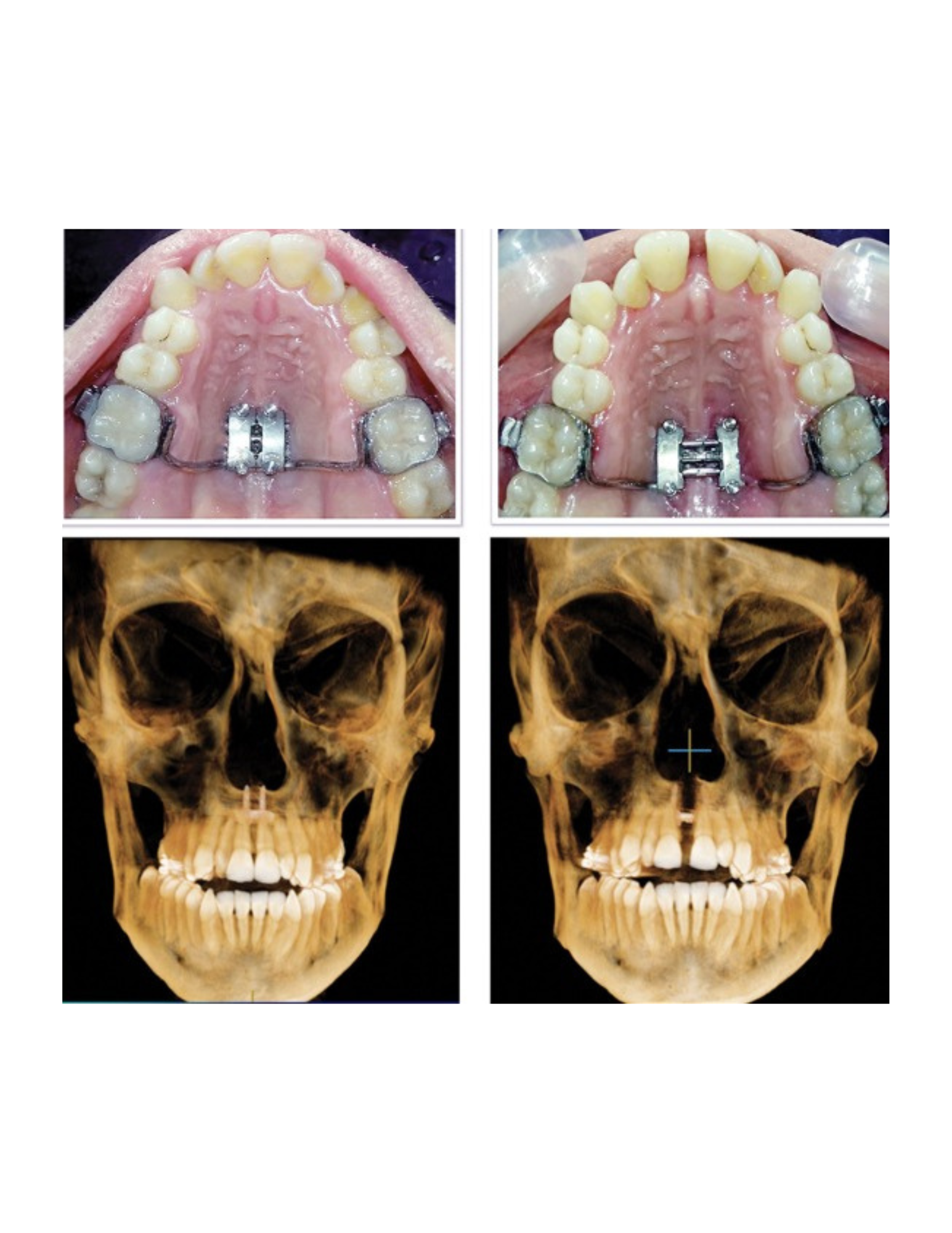 MARPE in Stockton – Adult Expander Treatment for Better Smiles & Breathing